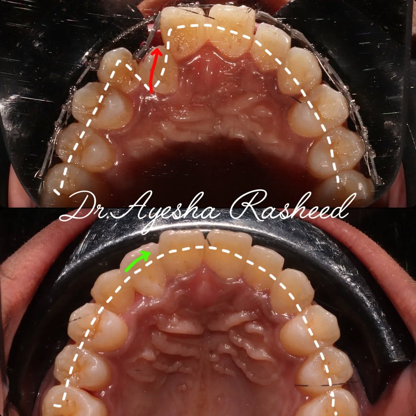 Bite Correction & Occlusion