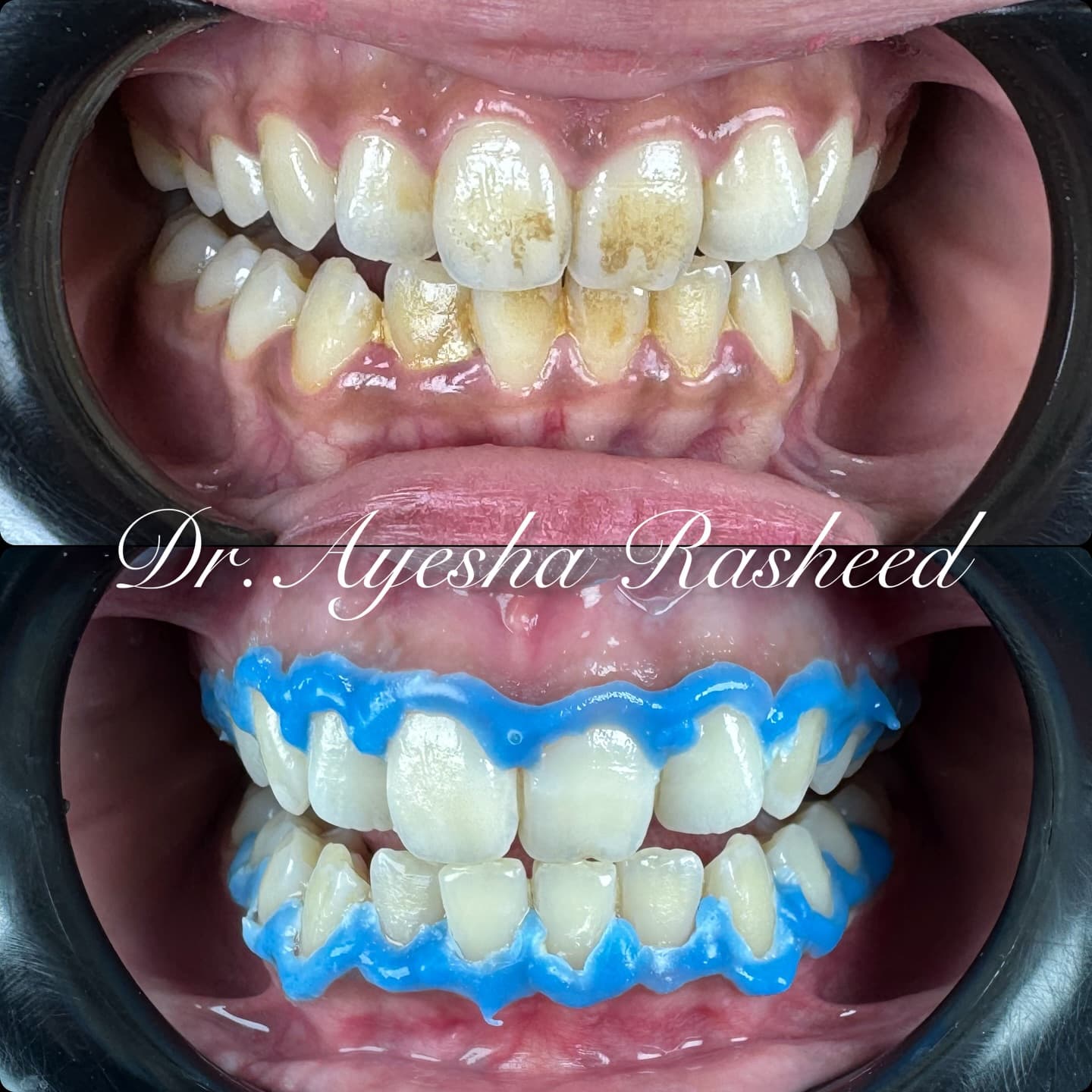 Teeth Whitening & Alignment