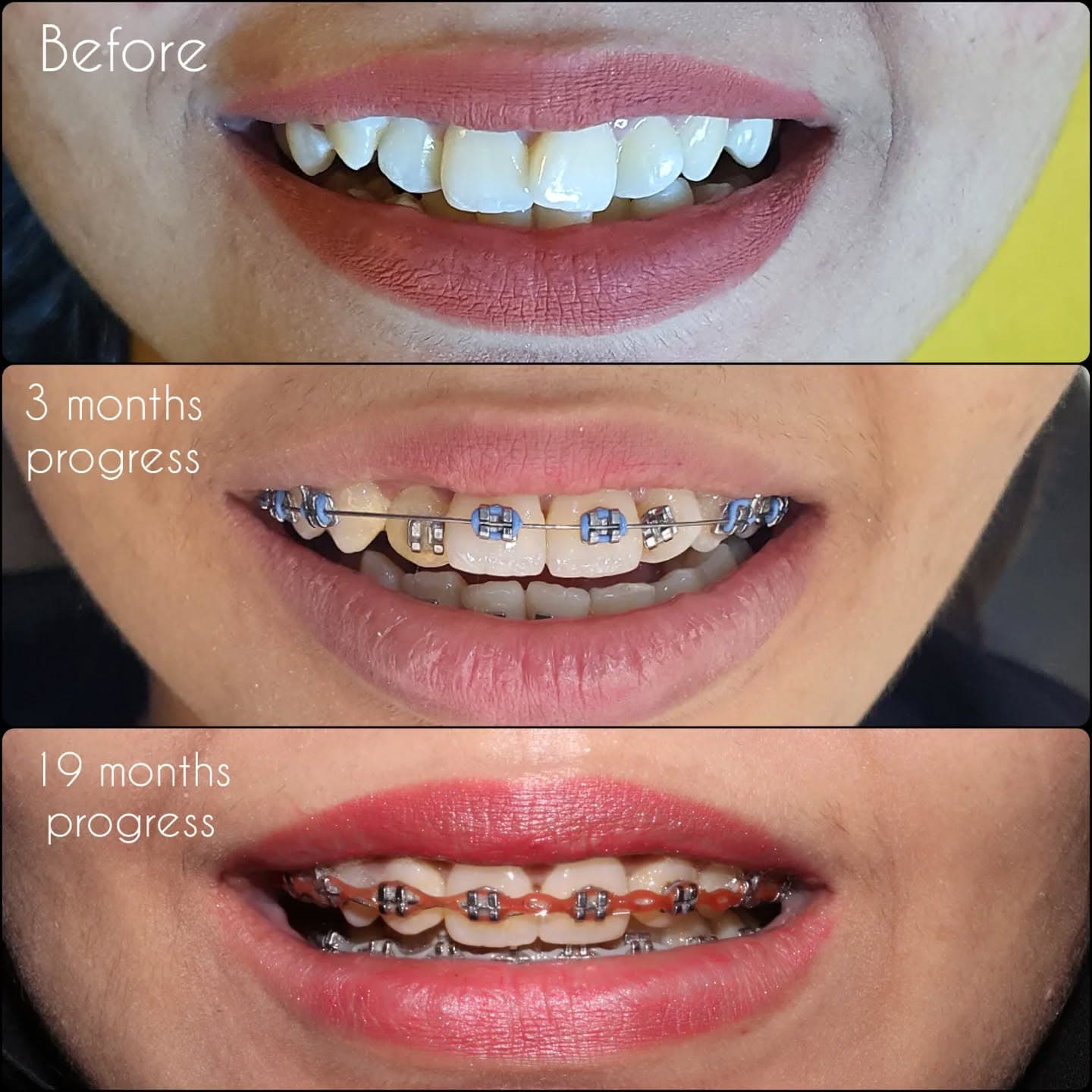 Orthodontic Treatment Progress